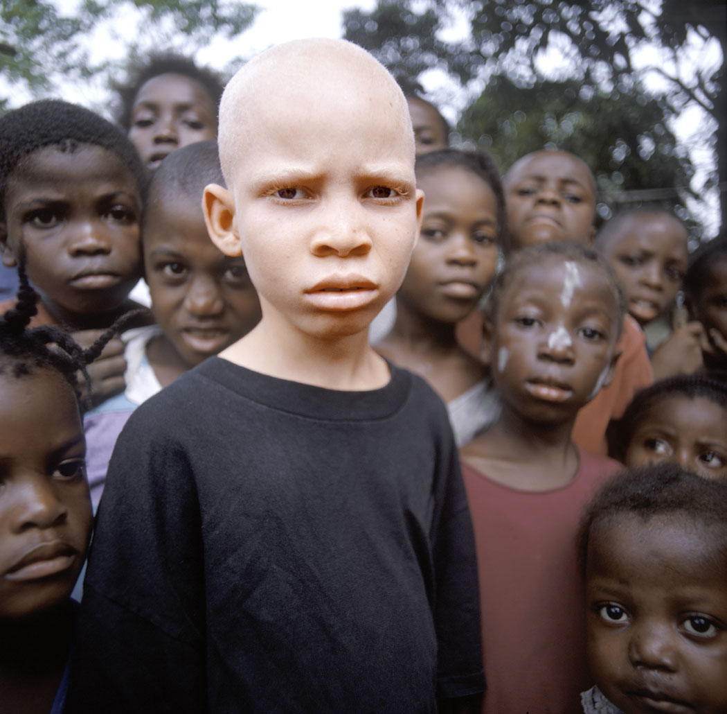 За что убивают людей-альбиносов в Африке | KLOOP.KG - Новости Кыргызстана